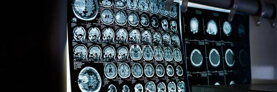 Choroba Parkinsona może mieć te nieoczywiste objawy. Jeśli je zauważysz, idź do lekarza